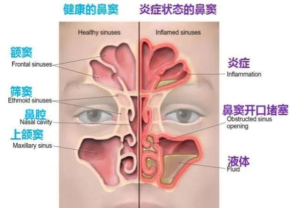 为什么一般不建议做鼻炎手术