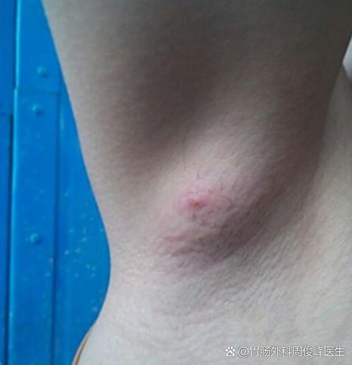 腋窝长了个硬疙瘩