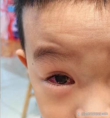 小孩眼睛右眼流眼水游戏截图