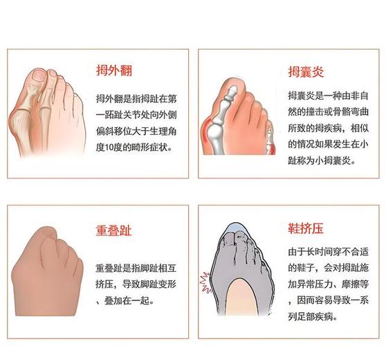 脚上大拇指旁边骨头突出疼怎么办
