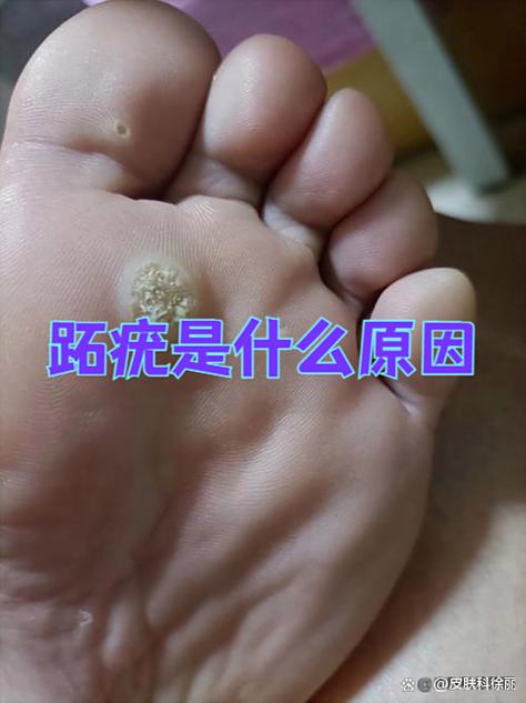 脚病毒感染怎么治疗