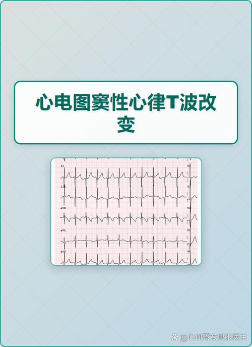 女性窦性心律t波低平