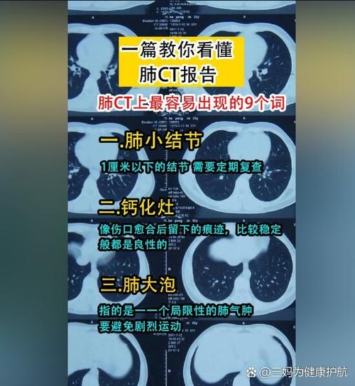诸城市中医院CT片子怎么看