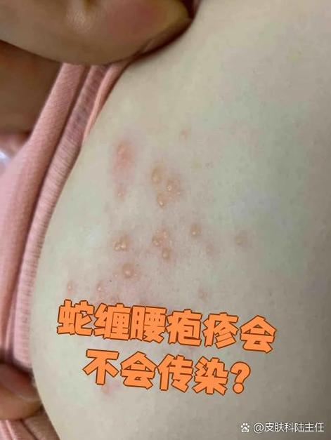 蛇被病毒会不会传染