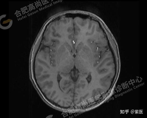头部CT为什么建议做MR