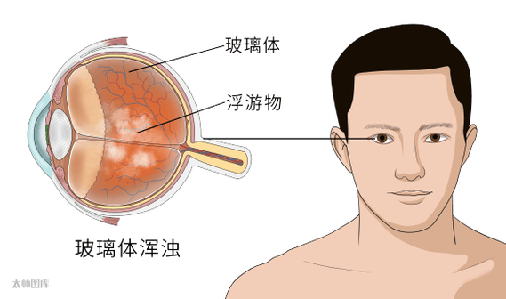 眼睛玻璃体混浊最好的治疗方法