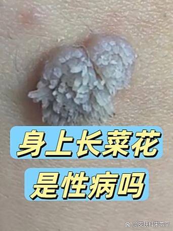 疣会自己消失吗游戏截图