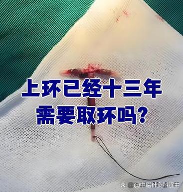 上环一般几年取环