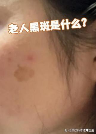 老年人脸上长黑斑是怎么回事缩略图