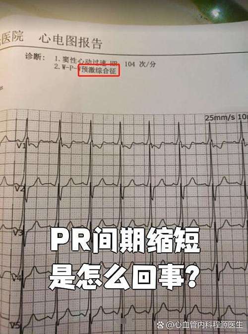 心电图短pr期间严重么