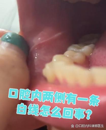 口腔两条线发白