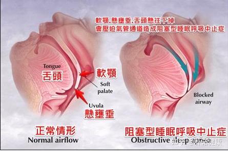 怎样睡觉才能不打呼噜