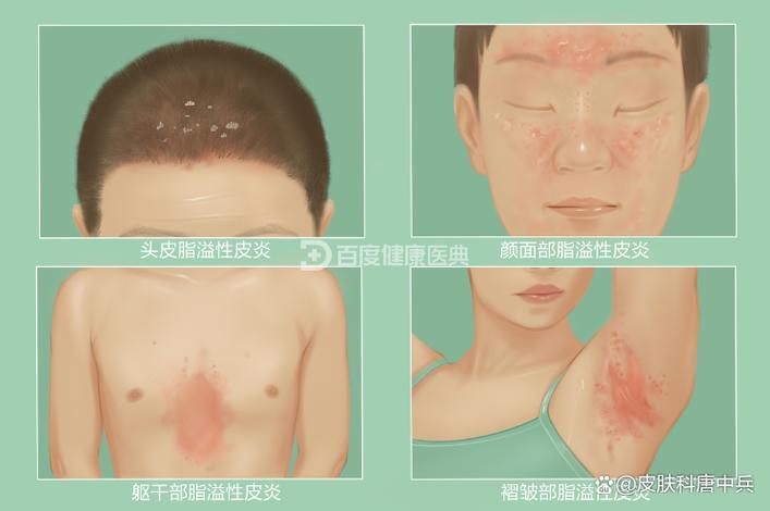 百度皮肤病图片识别
