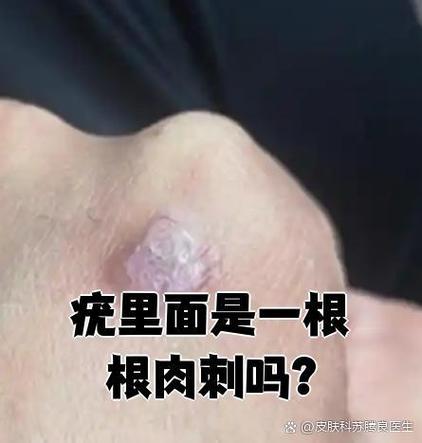 疣根拔出的根的样子截图