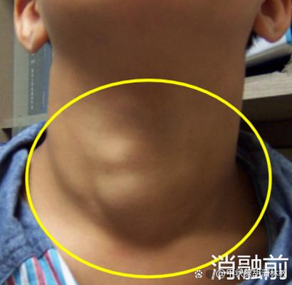 什么叫桥本甲状腺结节
