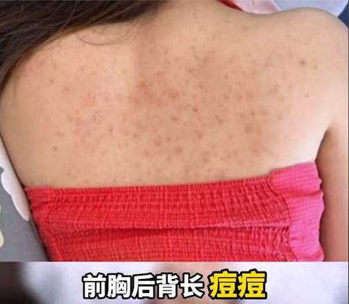 头皮痒长红色的痘痘是怎么回事