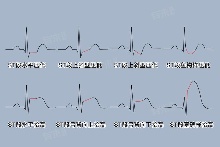 心电图的st段在哪里