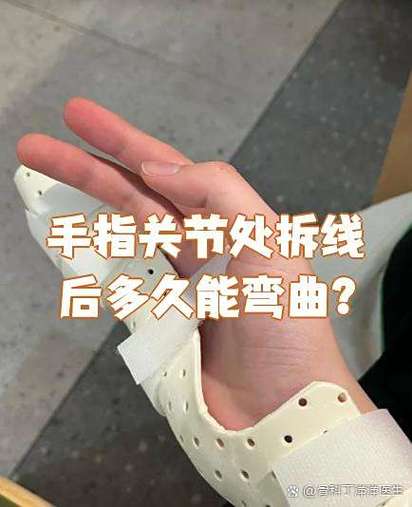 手指变形弯曲怎么恢复