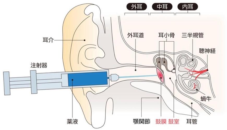鼓膜穿孔的症状表现
