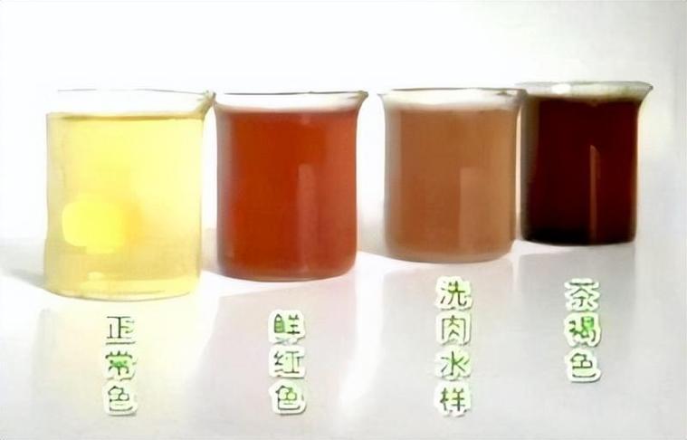 长期喝尿液对身体的危害
