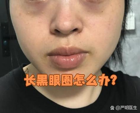 色素黑眼圈很重怎么去除