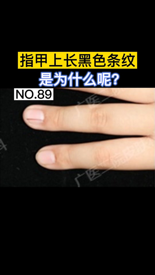指甲一条黑色竖线截图