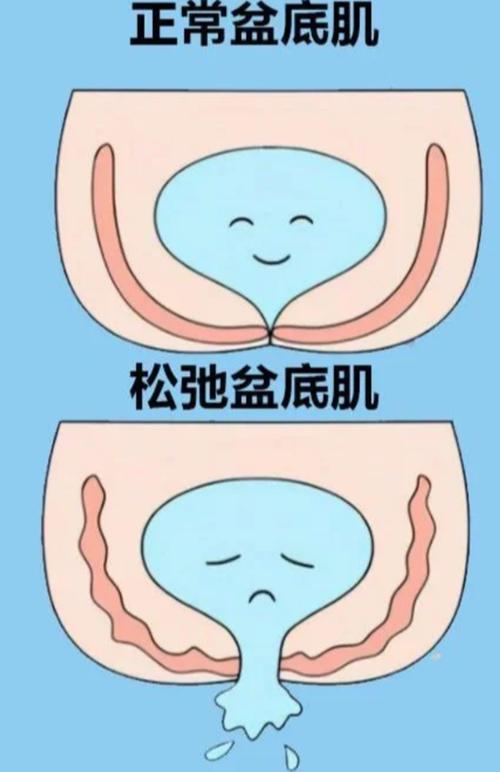 增强盆底肌的锻炼方法缩略图