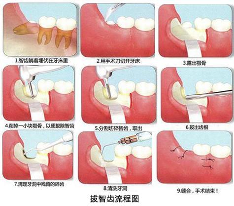 拔智齿后有个洞医生塞了什么