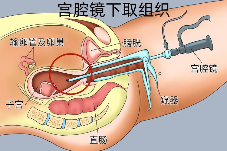 做宫腔镜要做什么检查