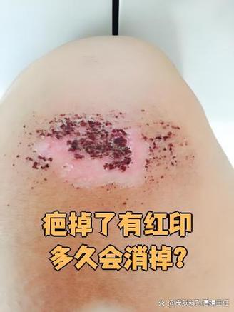 伤口新肉多久退红