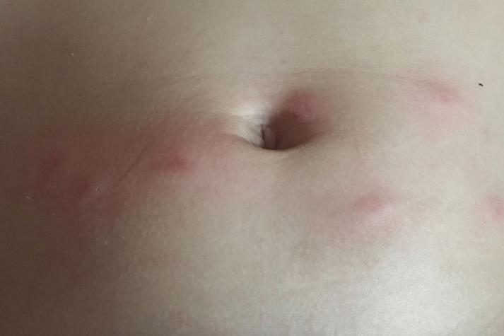 挠大腿肚脐眼痒