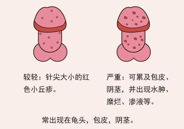 男性生殖红肿痒咋回事图标