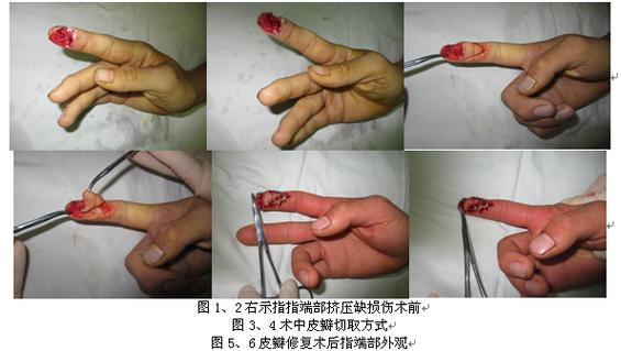 手指末端缺损做皮瓣手术