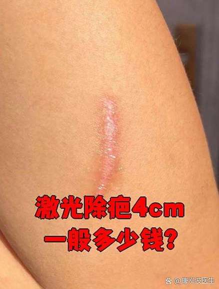 激光除疤4cm一般多少钱
