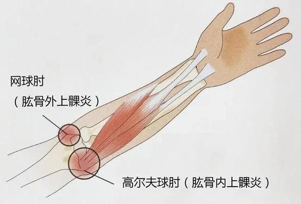 网球手疼是哪个部位