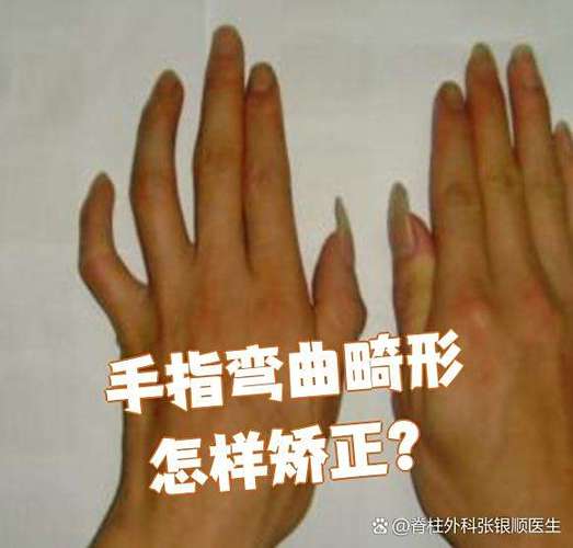 手指变形弯曲能矫正吗