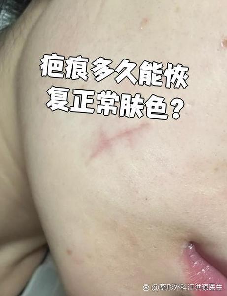 疤痕反黑多久能恢复正常