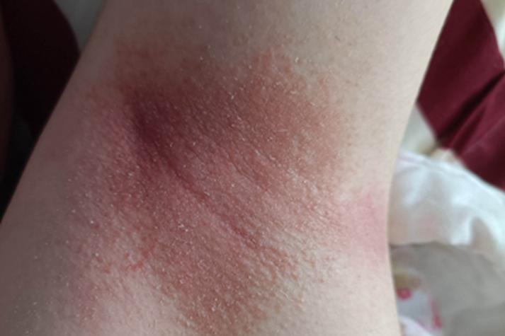 胳肢窝红点瘙痒是什么症状