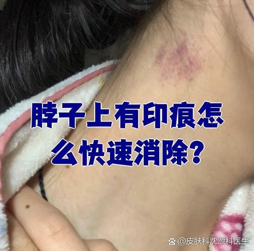 脖子上印痕怎么去掉