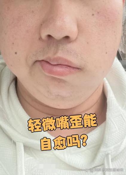 拍照嘴歪照镜子嘴不歪
