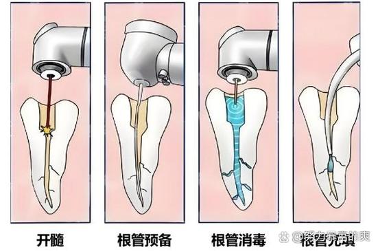 根管治疗多少钱一颗牙