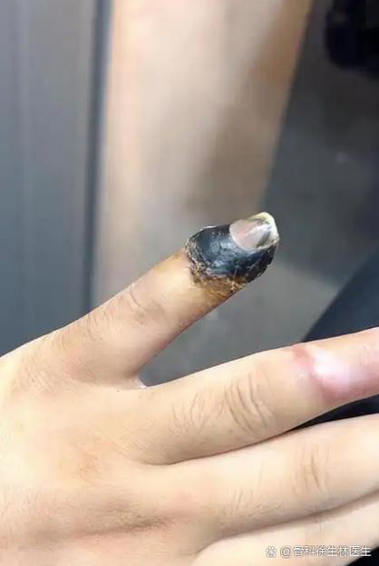 手指断了接上能恢复到什么程度