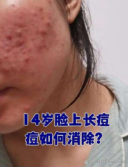 14岁女孩脸上长痘痘怎么办如何消除