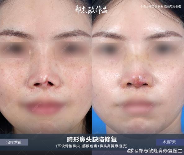 筋膜鼻尖会萎缩吗