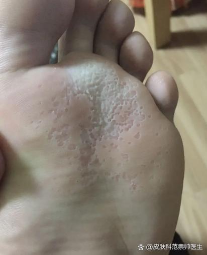 脚部真菌感染严重图片