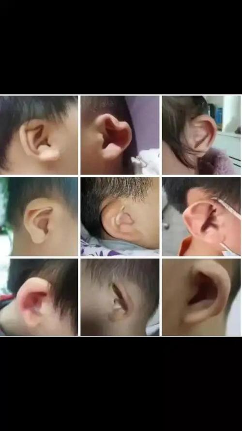 8种耳廓畸形图片