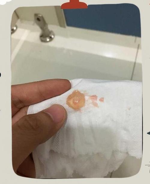 孕囊掉下来流了很多血