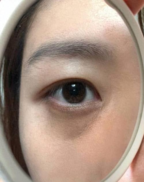 色素型黑眼圈