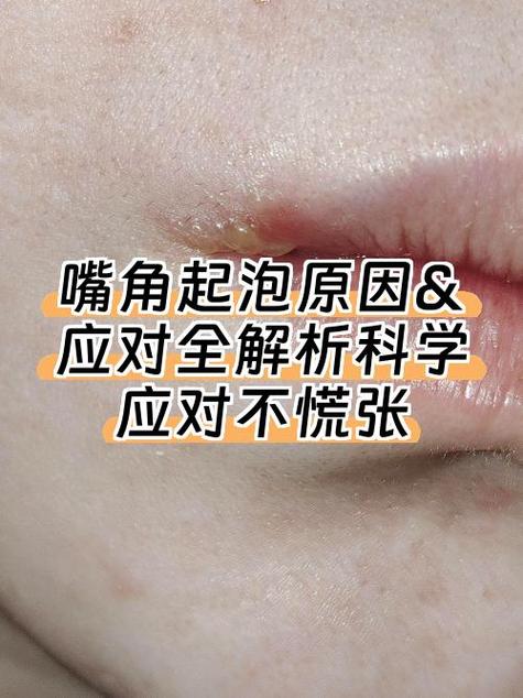 嘴上起泡怎么快速消除