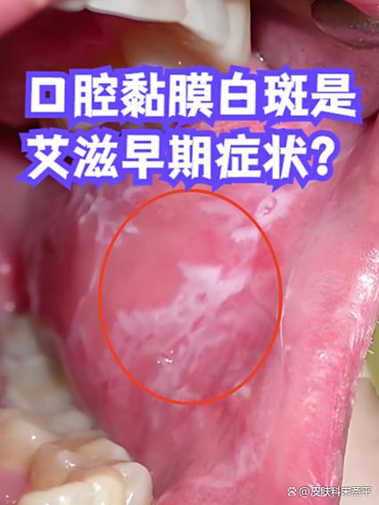 化验口腔黏膜能查出来什么病
